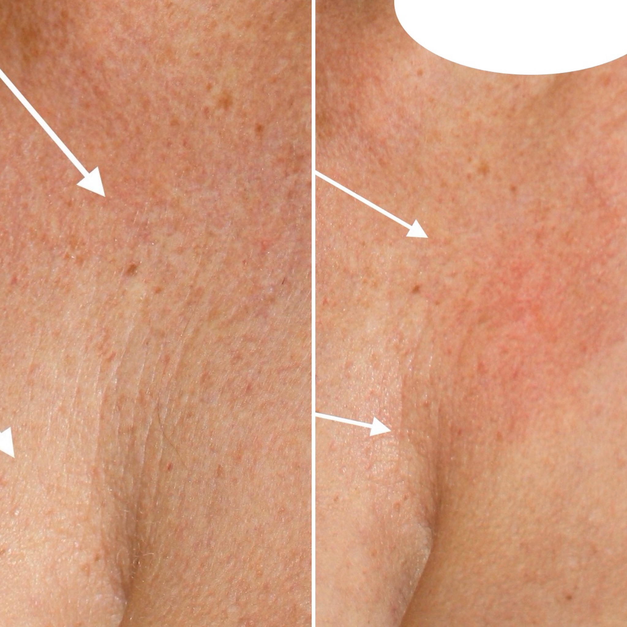 Décolleté treatment