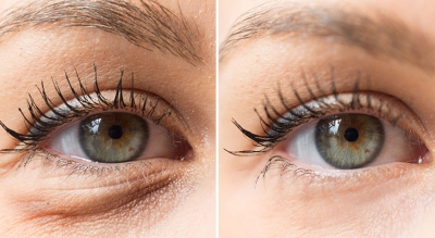 Blepharoplasty before/after