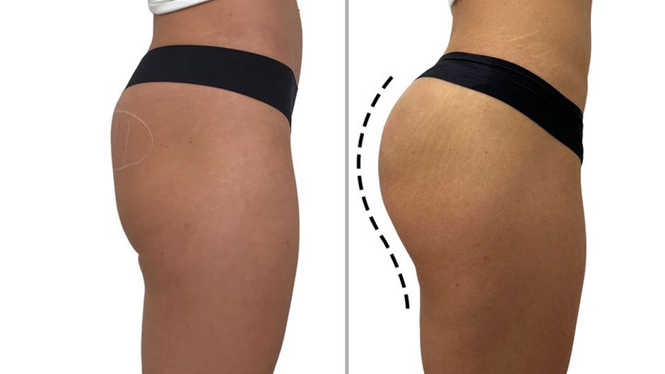 Butt Filler  Before
