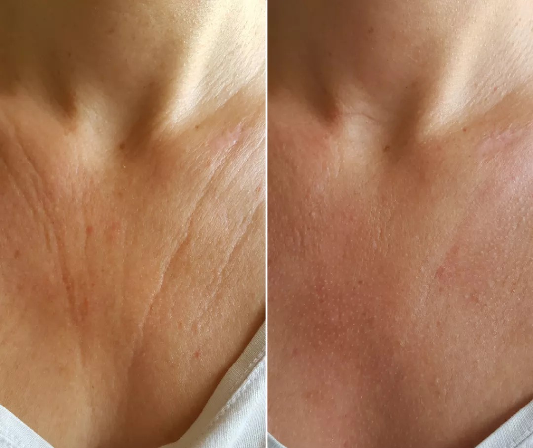 CO2 Laser Décolleté