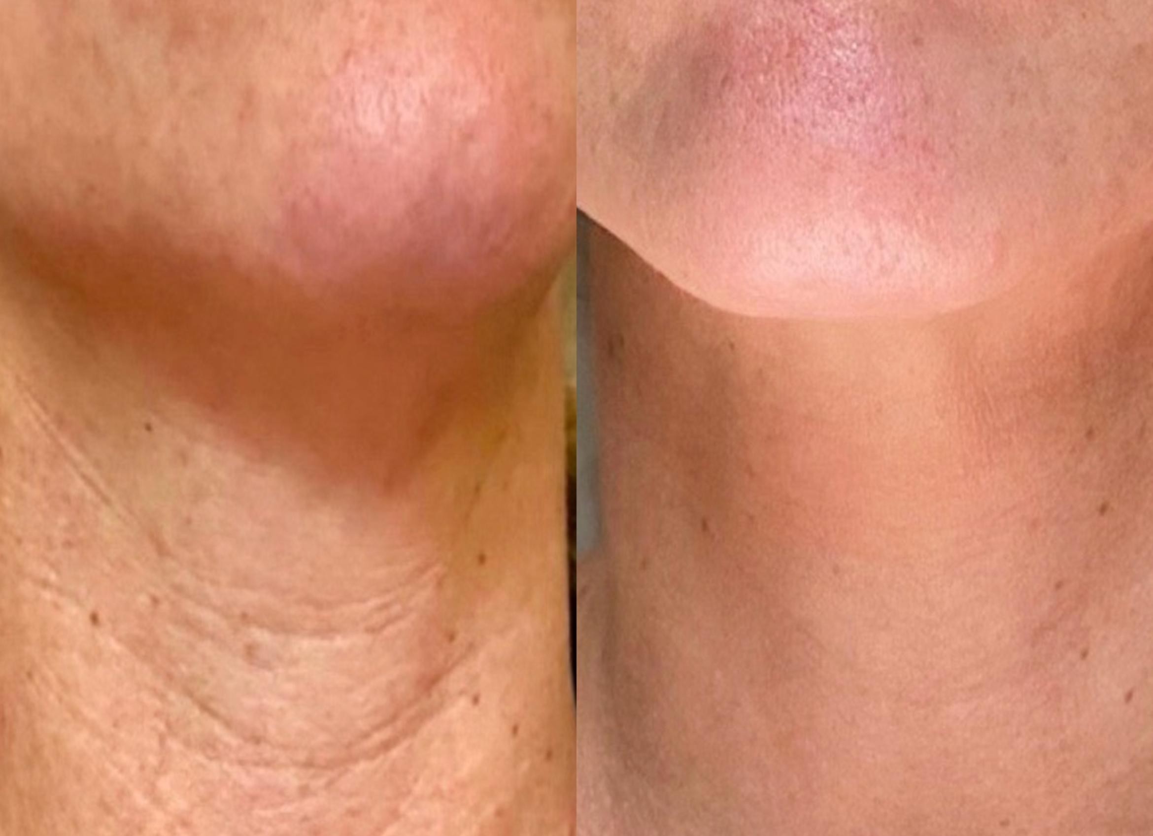 Dermapen neck