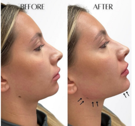 Jawline Filler Before