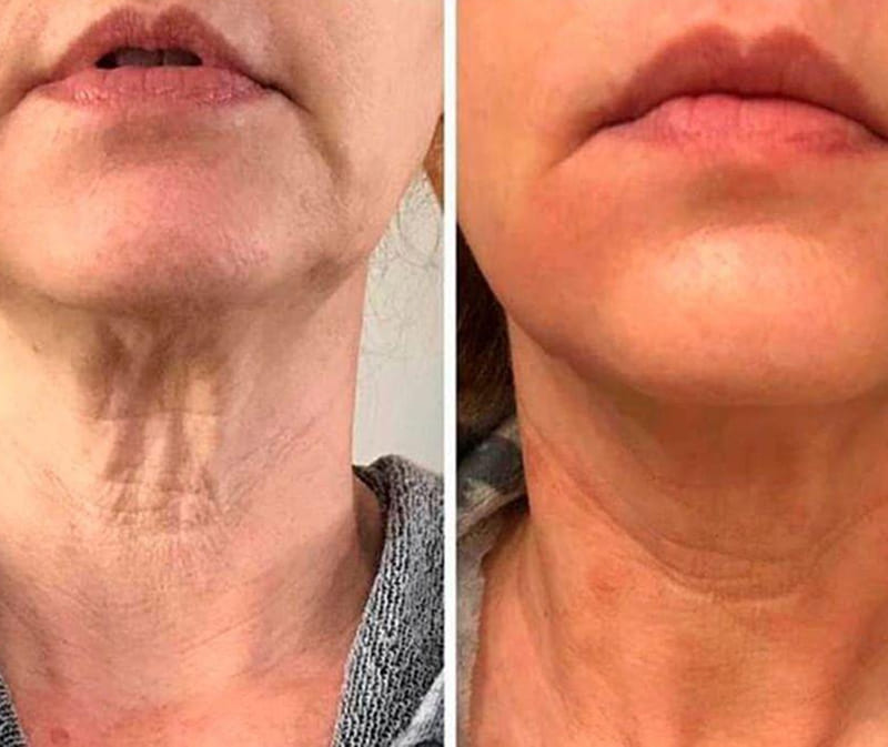 Neck lift