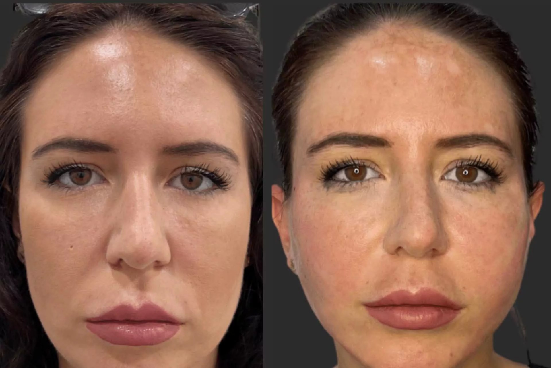 PDO Threads Full Face Lifting Before