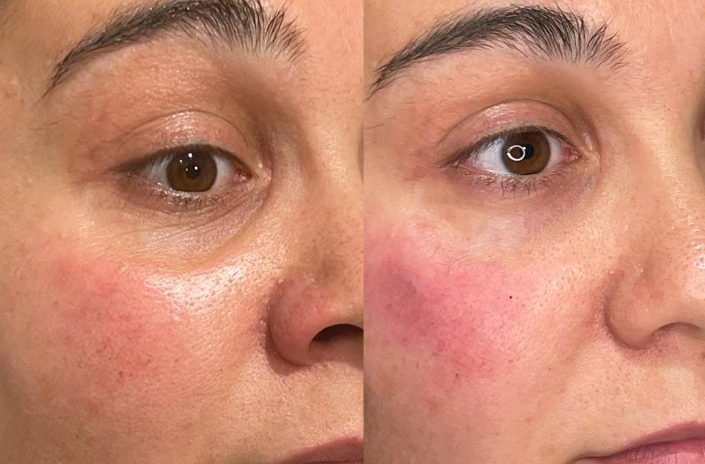 Tear trough filler