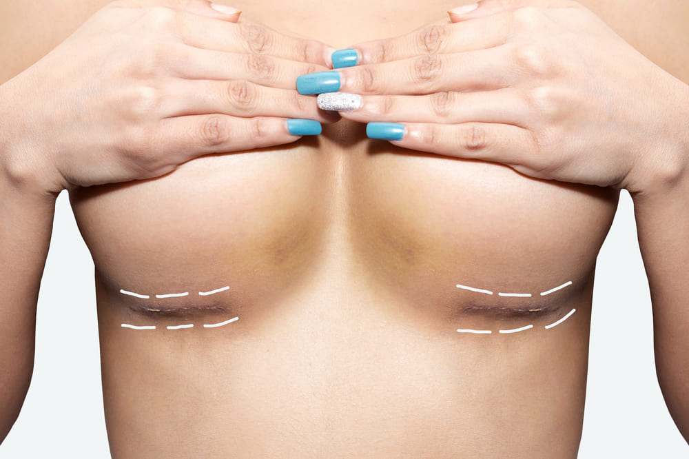 Breast Increase