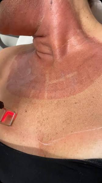 Laser CO₂  Décolleté