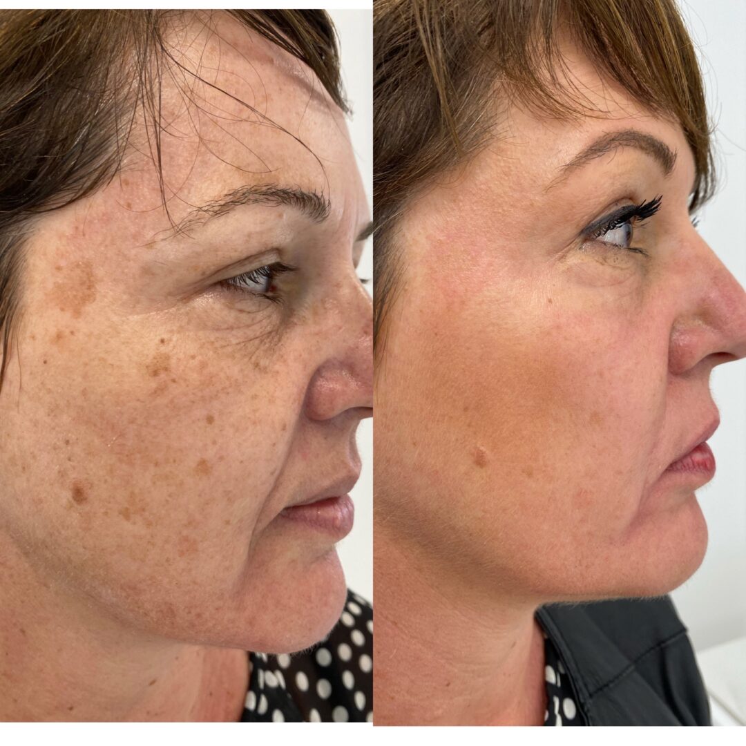 Laser CO₂ Full Face (Volto Completo)